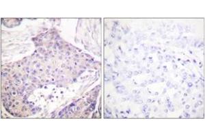 Immunohistochemistry analysis of paraffin-embedded human breast carcinoma tissue, using CARD6 Antibody. (CARD6 抗体  (AA 1-50))