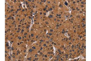 The image on the left is immunohistochemistry of paraffin-embedded Human liver cancer tissue using ABIN7191712(NRAS Antibody) at dilution 1/40, on the right is treated with synthetic peptide. (GTPase NRas 抗体)