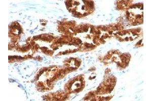 IHC staining of human prostate carcinoma with TAG-72 antibody (TAG-72 抗体)