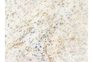 ABIN6257817 and ABIN6274533 at 1/100 staining human prostate carcinoma by IHC-P. (HMG20B 抗体  (N-Term))