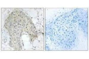 Immunohistochemistry analysis of paraffin-embedded human breast carcinoma tissue using PPP1R2 (Ab-120/121) antibody. (PPP1R2 抗体  (Ser120, Ser121))