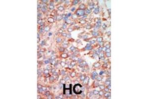 Formalin-fixed and paraffin-embedded human cancer tissue reacted with the primary antibody, which was peroxidase-conjugated to the secondary antibody, followed by AEC staining. (STK24 抗体  (C-Term))