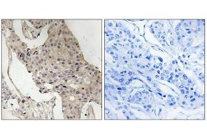 Immunohistochemistry analysis of paraffin-embedded human breast carcinoma tissue, using Gab2 (Phospho-Ser623) antibody. (GAB2 抗体  (pSer623))