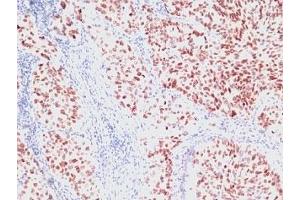 Formalin-fixed, paraffin-embedded human lung carcinoma stained with NKX2. (NKX2-1 抗体)