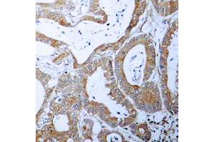Immunohistochemical analysis of BCLX staining in human colon cancer formalin fixed paraffin embedded tissue section.