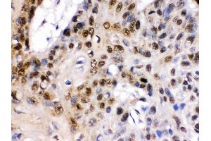 TCF7L1 was detected in paraffin-embedded sections of human oesophagus squama cancer tissues using rabbit anti- TCF7L1 Antigen Affinity purified polyclonal antibody at 1 μg/mL. (TCF7L1 抗体  (C-Term))