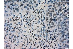 Immunohistochemical staining of paraffin-embedded Adenocarcinoma of breast tissue using anti-DHFR mouse monoclonal antibody. (Dihydrofolate Reductase 抗体)