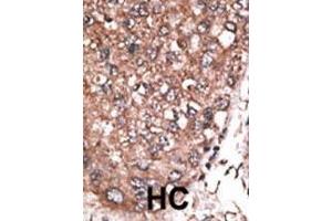 Formalin-fixed and paraffin-embedded human cancer tissue reacted with the primary antibody, which was peroxidase-conjugated to the secondary antibody, followed by AEC staining. (HAND2 抗体  (C-Term))