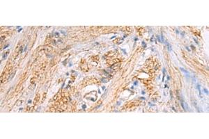Immunohistochemistry of paraffin-embedded Human gastric cancer tissue using TMOD3 Polyclonal Antibody at dilution of 1:70(x200) (TMOD3 抗体)