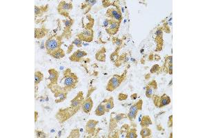 Immunohistochemistry of paraffin-embedded human liver cancer using BTD antibody at dilution of 1:100 (40x lens). (BTD 抗体)