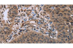 Immunohistochemistry of paraffin-embedded Human lung cancer using HOMER1 Polyclonal Antibody at dilution of 1:50 (HOMER1 抗体)