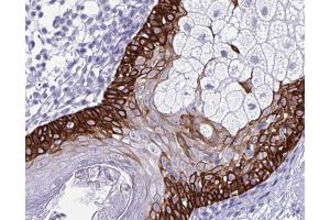 ABIN6266574 at 1/100 staining human colon cancer tissue by IHC-P. (Cytokeratin 5 抗体  (C-Term))