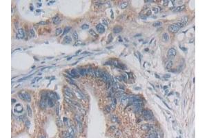 Detection of DSP in Human Colorectal cancer Tissue using Polyclonal Antibody to Desmoplakin (DSP) (Desmoplakin 抗体  (AA 2609-2822))
