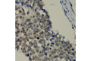 Immunohistochemistry of paraffin-embedded human lung cancer using TEAD1 antibody at dilution of 1:100 (x40 lens). (TEAD1 抗体)