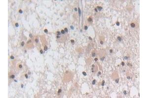 Detection of PLN in Human Glioma Tissue using Polyclonal Antibody to Phospholamban (PLN)