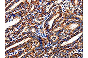 The image is immunohistochemistry of paraffin-embedded Human thyroid cancer tissue using ABIN7129012(COX19 Antibody) at dilution 1/50. (COX19 抗体)