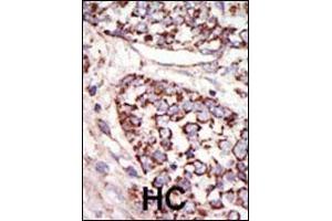 Formalin-fixed and paraffin-embedded human cancer tissue reacted with the primary antibody, which was peroxidase-conjugated to the secondary antibody, followed by DAB staining. (ERK1 抗体  (N-Term))