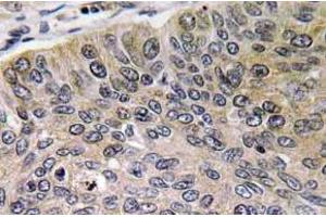 Immunohistochemistry (IHC) analyzes of Cathepsin E antibody in paraffin-embedded human lung carcinoma tissue. (Cathepsin E 抗体)