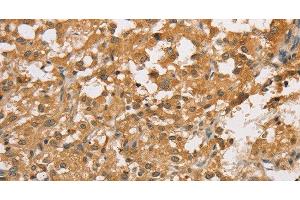 Immunohistochemistry of paraffin-embedded Human thyroid cancer using ARHGEF5 Polyclonal Antibody at dilution of 1:50 (ARHGEF5 抗体)