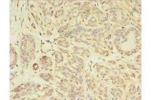 Immunohistochemistry of paraffin-embedded human breast cancer using ABIN7163630 at dilution of 1:100 (PDGFRB 抗体  (AA 901-1106))