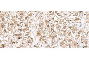 Immunohistochemistry of paraffin-embedded Human liver cancer tissue using RPL35 Polyclonal Antibody at dilution of 1:70(x200) (RPL35 抗体)