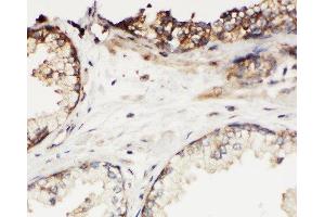 Anti-Kallikrein 11 antibody, IHC(P) IHC(P): Human Prostatic Cancer Tissue (Kallikrein 11 抗体  (C-Term))