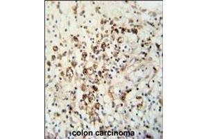 HAUS5 Antibody (N-term) (ABIN651423 and ABIN2840230) immunohistochemistry analysis in formalin fixed and paraffin embedded human colon carcinoma followed by peroxidase conjugation of the secondary antibody and DAB staining. (HAUS5 抗体  (N-Term))