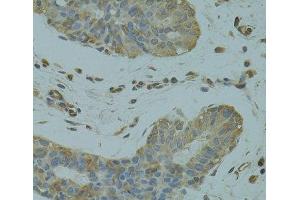 Immunohistochemistry of paraffin-embedded Human breast cancer using DGKQ Polyclonal Antibody at dilution of 1:100 (40x lens). (DGKQ 抗体)