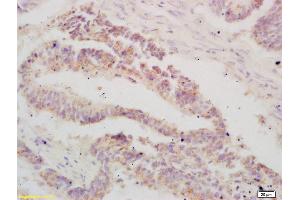 Formalin-fixed and paraffin embedded human colon carcinoma labeled with Anti-ATF3 Polyclonal Antibody, Unconjugated (ABIN669561) at 1:200 followed by conjugation to the secondary antibody and DAB staining (ATF3 抗体  (AA 51-150))