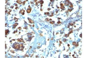 Formalin-fixed, paraffin-embedded human Gastric Carcinoma stained with MUC3 Mouse Monoclonal Antibody (M3. (MUC3A 抗体)