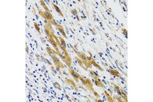 Immunohistochemistry of paraffin-embedded human liver cancer using PLA2G2D antibody (ABIN5974036) at dilution of 1/100 (40x lens). (PLA2G2D 抗体)