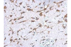 IHC-P Image Immunohistochemical analysis of paraffin-embedded human hepatoma, using UGT1A, antibody at 1:500 dilution. (Ugt1 抗体)