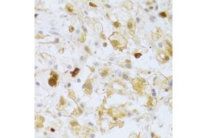 Immunohistochemistry of paraffin-embedded human brain astrocytoma using FCN1 Antibody (ABIN2562567) at dilution of 1:100 (40x lens). (FCN1 抗体)