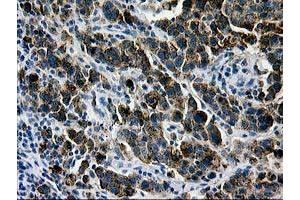 Immunohistochemical staining of paraffin-embedded Carcinoma of Human lung tissue using anti-LGALS3BP mouse monoclonal antibody. (LGALS3BP 抗体  (AA 19-300))