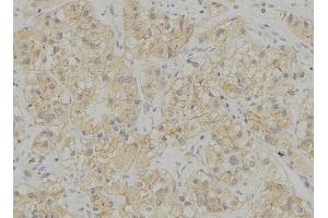 ABIN6272934 at 1/100 staining Human breast cancer tissue by IHC-P. (STING/TMEM173 抗体  (Internal Region))