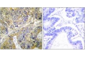 Immunohistochemistry analysis of paraffin-embedded human colon carcinoma tissue, using EPS8L3 Antibody. (EPS8-Like 3 抗体  (AA 401-450))