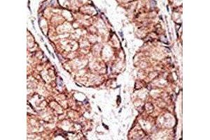 IHC analysis of FFPE human breast carcinoma tissue stained with the TLR5 antibody (TLR5 抗体  (AA 71-102))