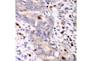 Immunohistochemistry of paraffin-embedded human gastric cancer using S100A12 antibody (ABIN6291358) at dilution of 1:100 (40x lens). (S100A12 抗体)