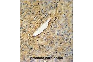 CEP63 Antibody (Center) (ABIN651000 and ABIN2840033) IHC analysis in formalin fixed and paraffin embedded prostate carcinoma followed by peroxidase conjugation of the secondary antibody and DAB staining. (CEP63 抗体  (AA 520-548))