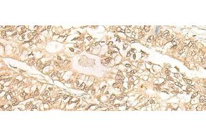 Immunohistochemistry of paraffin-embedded Human gastric cancer tissue using DMC1 Polyclonal Antibody at dilution of 1:30(x200) (DMC1 抗体)