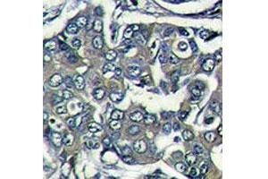 IHC analysis of formalin fixed paraffin embedded human breast carcinoma stained with EIF4E2 antibody