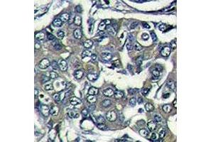 IHC analysis of formalin fixed paraffin embedded human breast carcinoma stained with EIF4E2 antibody (EIF4E2 抗体  (AA 12-41))