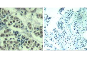 Immunohistochemical analysis of paraffin-embedded human breast carcinoma tissue using MDM2 (Ab-166) Antibody (E021550). (MDM2 抗体)