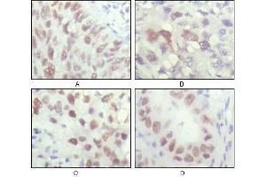 Immunohistochemical analysis of paraffin-embedded human lung carcinoma (A), liver carcinoma (B), breast carcinoma (C) and kiney carcinoma (D), showing nuclear localization with DAB staining using CHK2 antibody. (CHEK2 抗体  (AA 481-531))