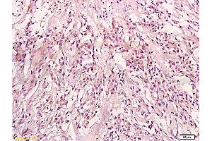Formalin-fixed and paraffin embedded: human endometrium tissue labeled with Anti-KRAS Polyclonal Antibody (ABIN736671), Unconjugated at 1:200, followed by conjugation to the secondary antibody and DAB staining (K-RAS 抗体  (AA 25-130))