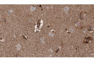 ABIN6279767 at 1/100 staining Human brain cancer tissue by IHC-P. (ARHGAP20 抗体  (Internal Region))