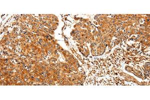 Immunohistochemistry of paraffin-embedded Human esophagus cancer using TPM2 Polyclonal Antibody at dilution of 1:30 (TPM2 抗体)