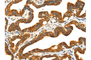 The image on the left is immunohistochemistry of paraffin-embedded Human thyroid cancer tissue using ABIN7192030(PRSS50 Antibody) at dilution 1/30, on the right is treated with synthetic peptide. (MASP1 抗体)