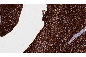 ABIN6268889 at 1/100 staining Human urothelial cancer tissue by IHC-P. (FAS 抗体  (C-Term))