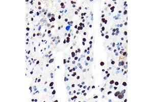 Immunohistochemistry of paraffin-embedded human oophoroma using HD antibody (ABIN7267708) at dilution of 1:100 (40x lens).